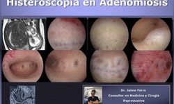 Adenomiosis e histeroscopía