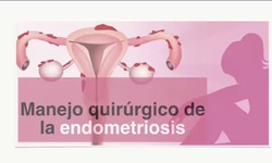 Manejo quirúrgico de la endometriosis